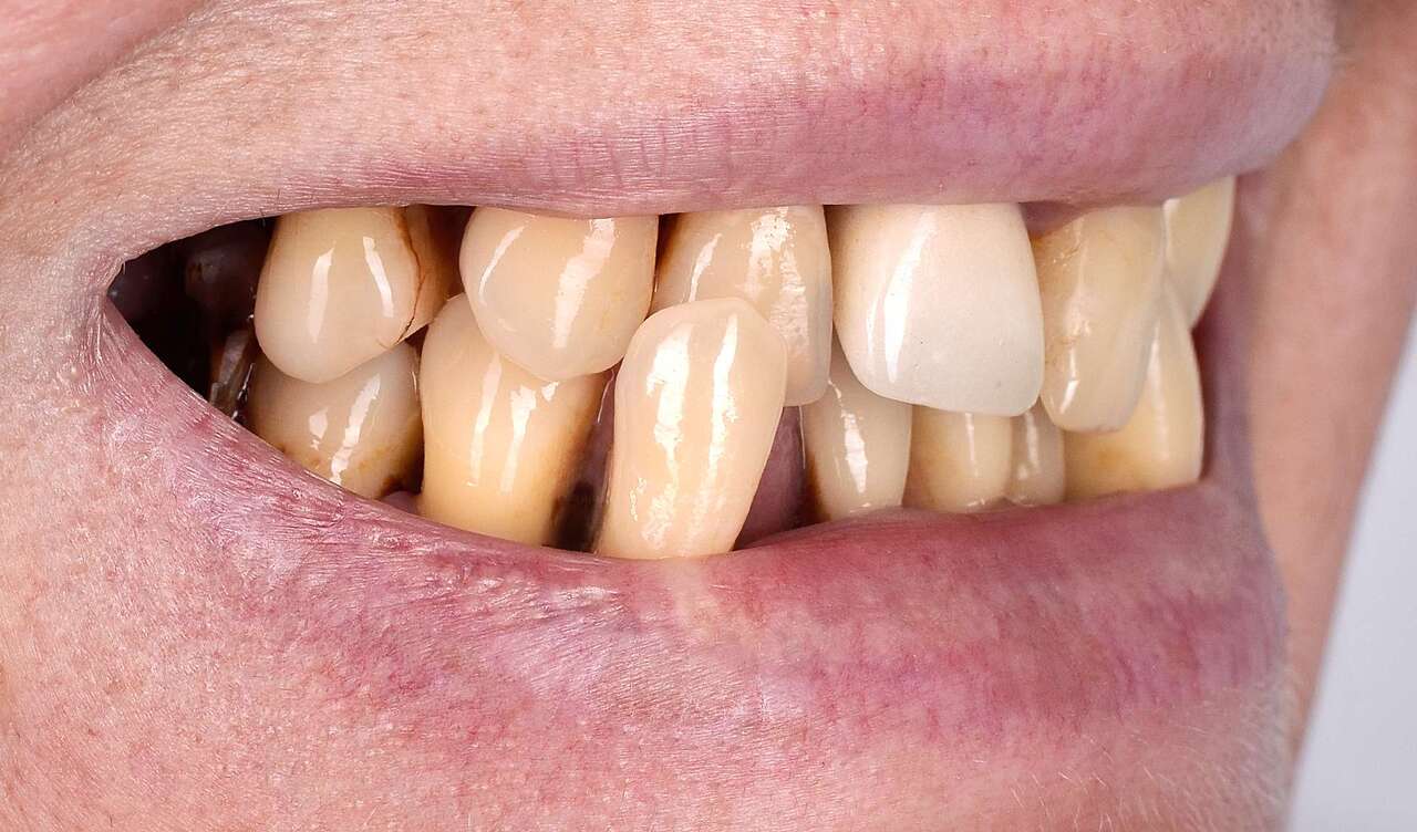 При об'єктивному огляді більшість зубів мали сильну рухливість та підлягали видаленню.