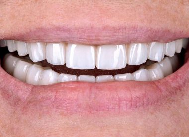 В одне відвідування були видалені всі зуби, встановлені імплантати на обидві щелепи, виготовлені тимчасові коронки.