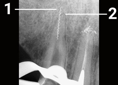 В верхнем клыке, который лечили в другой клинике, был обнаружен отломок инструмента, который по данным рентгенографии на несколько миллиметров был выведен за верхушку корня зуба. Зуб не беспокоил, однако отломок было решено извлечь, так как он неизбежно подвергается коррозии и зуб может начать болеть в любое время. 1 – спиралевидный фрагмент внутриканального инструмента 2 –...