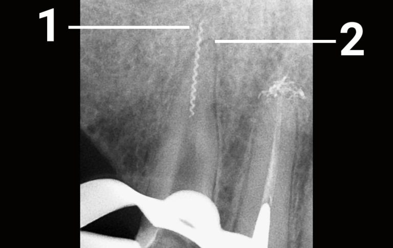 В верхнем клыке, который лечили в другой клинике, был обнаружен отломок инструмента, который по данным рентгенографии на несколько миллиметров был выведен за верхушку корня зуба. Зуб не беспокоил, однако отломок было решено извлечь, так как он неизбежно подвергается коррозии и зуб может начать болеть в любое время. 1 – спиралевидный фрагмент внутриканального инструмента 2 –...
