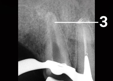 Обломок инструмента извлечен. Рентген зуба до пломбировки канала. 3 – фрагмент полностью извлечен