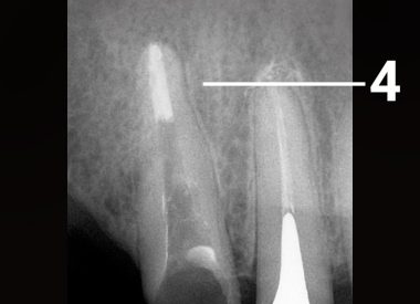 After removing the fragment and using a dental microscope, the treatment was completed by filling of the root canal and indirect restorations (crowns). 4 – tooth after root canal sealing