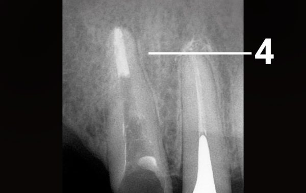 Extraction of an instrument fragment from a tooth root canal