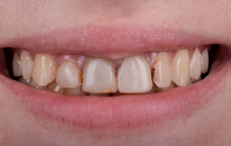 Replacement of restorations with teeth discoloration for ceramic veneers