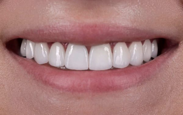 Replacement of restorations with teeth discoloration for ceramic veneers