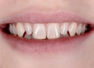 A patient came to the dental clinic complaining of an unsatisfactory form of her maxillary lateral incisors. She expected to make her teeth 12 and 22 more proportional to the central incisors.