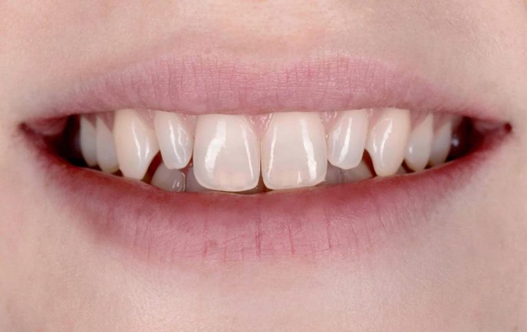 Change of incisor shape using ceramic veneers