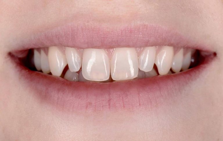 Пациентка обратилась в стоматологическую клинику с жалобами на неудовлетворительную форму вторых резцов верхней челюсти. Пожелание было сделать 12 и 22 зубы более пропорциональными по отношению к центральным резцам.