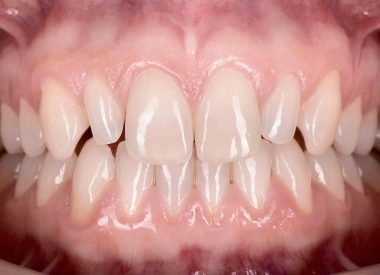 The dentists suggested preliminary wax-up of the lateral incisors (the wax-up) and its subsequent placement into the oral cavity (the mock-up).