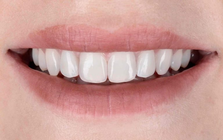 Change of incisor shape using ceramic veneers