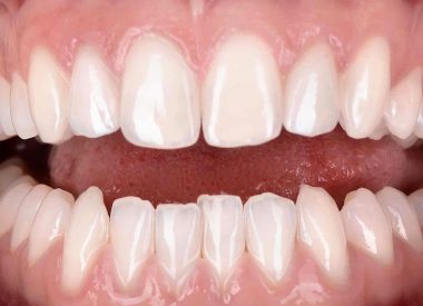 After manufacturing in the dental laboratory, the ceramic veneers were fixed in the oral cavity.