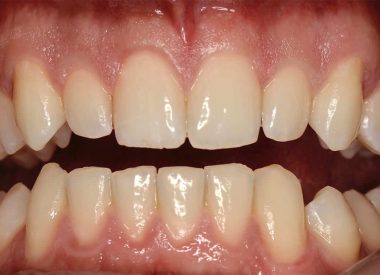 The patient wished to undergo a treatment at the clinic in order to achieve a beautiful smile and elongation of the corner teeth.