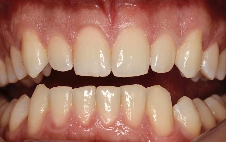 The patient wished to undergo a treatment at the clinic in order to achieve a beautiful smile and elongation of the corner teeth.