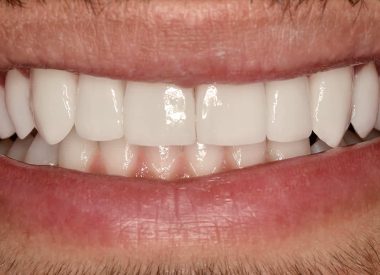 Following detailed analysis and preparation for the treatment, the teeth were adjusted (filed) in preparation for the placement of ceramic veneers.