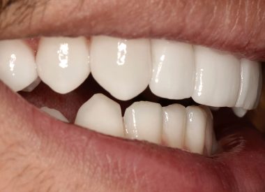 Veneers were made and placed within 7 days.