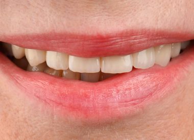 Пациентка обратилась к нам с пожеланием изменить форму, наклон и цвет зубов. В анамнезе нет противопоказаний к стоматологическому лечению.