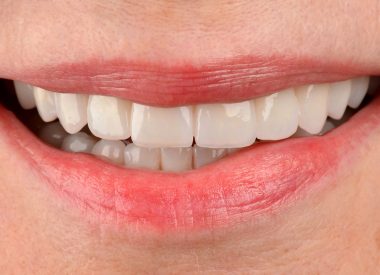 Після затвердження кольору і форми зубів, ми розпочали тотальну реабілітацію зубів за допомогою цирконієвих коронок.