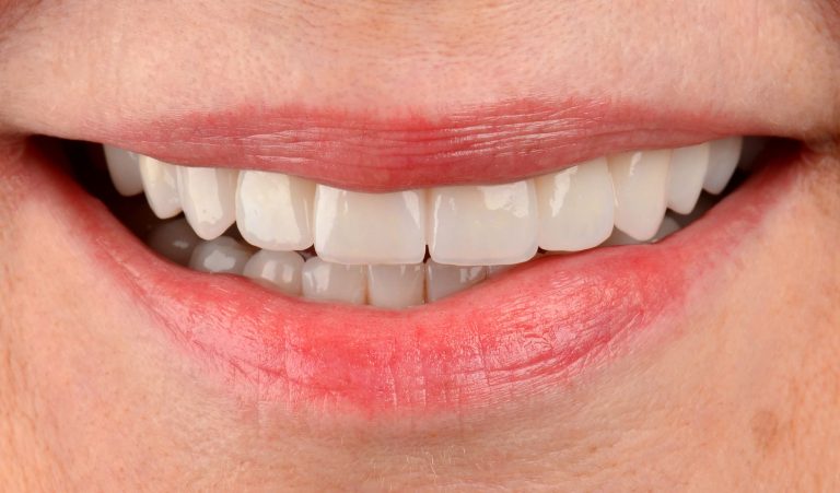 Digital smile design and production of CAD/CAM restorations in a complex aesthetic case