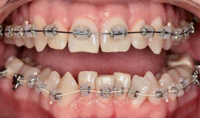 Adult age of braces