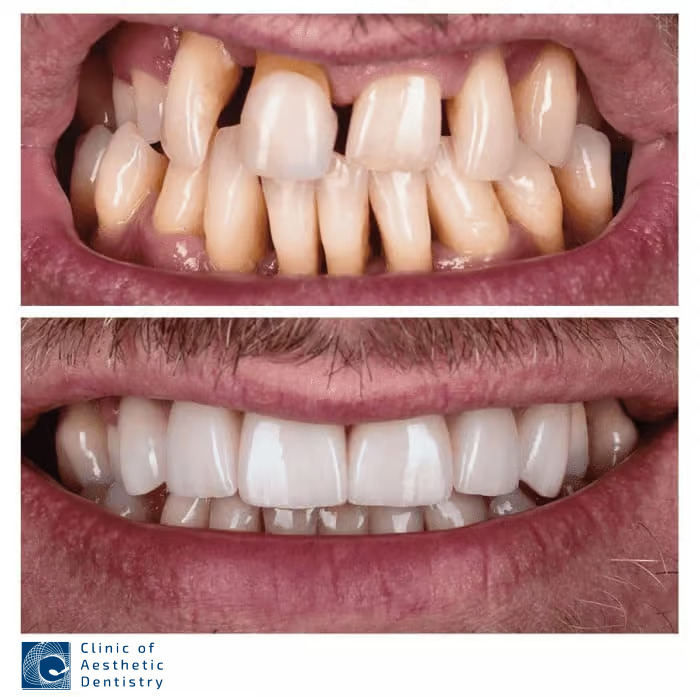 Aesthetic Dental Restoration