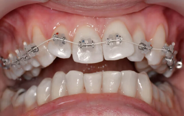Allergy to the brace materials