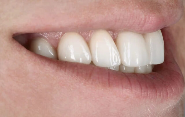 Crossbite Correction