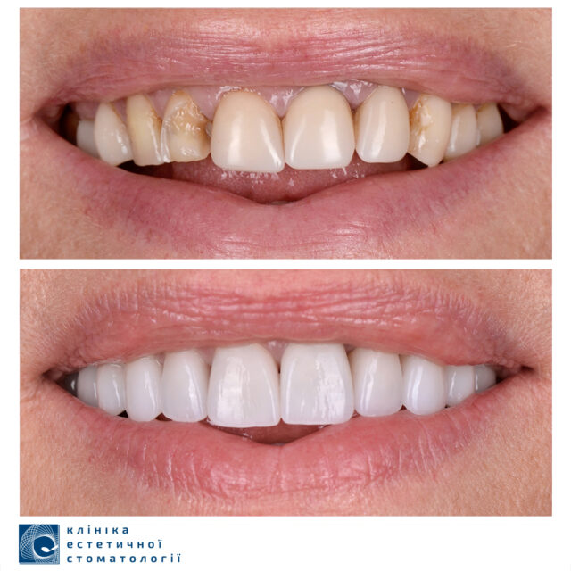 Gummy Smile and Ways to Fix It photo