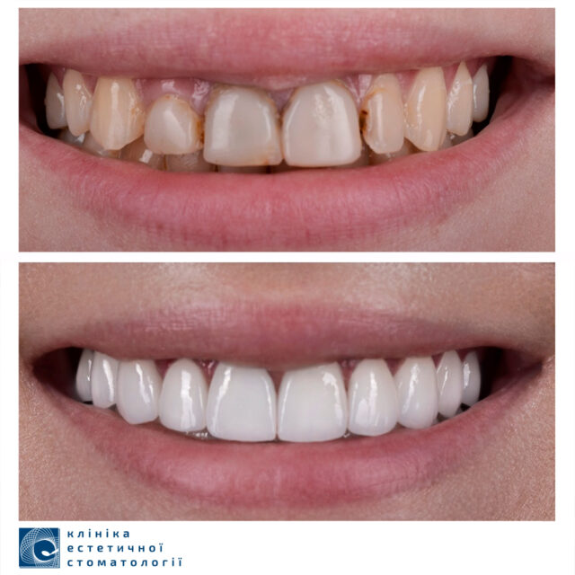 Gummy Smile and Ways to Fix It photo