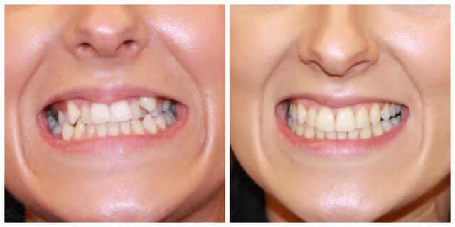 Діагностика прикусної аномалії