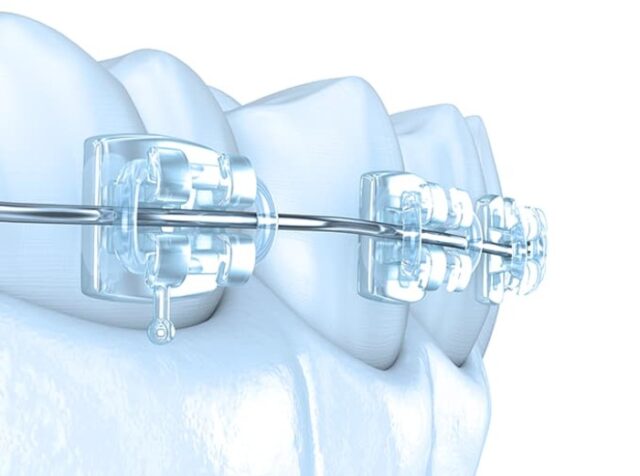 Effectiveness of Braces