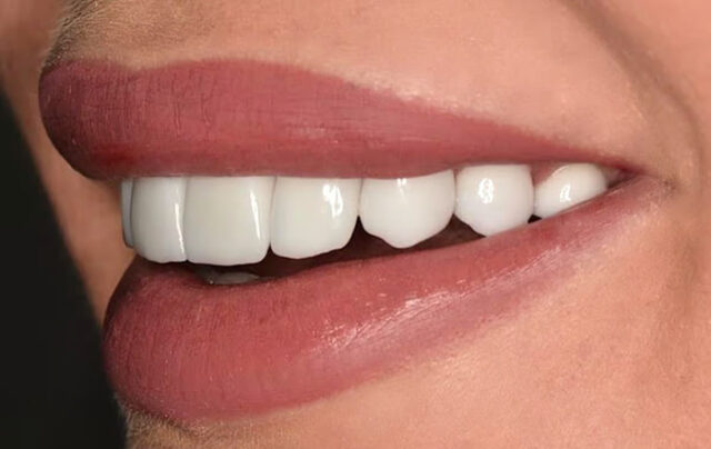 Enhancing Lip Volume