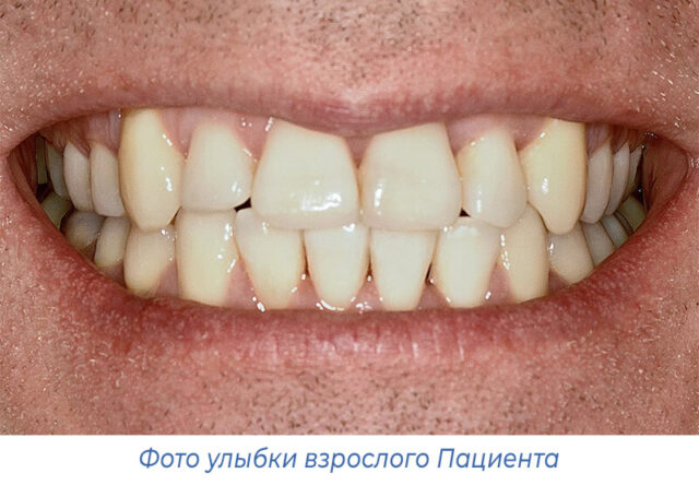 Фото улыбки взрослого Пациента
