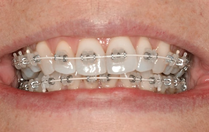 Good Personal Hygiene and Care of Braces