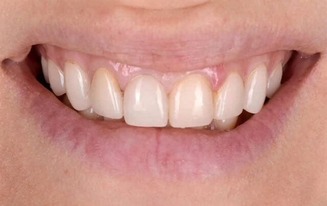 Gummy Smile and Ways to Fix It