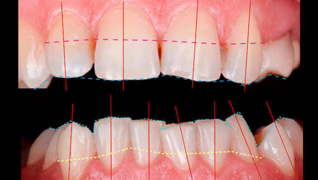 Gummy Smile Diagnosis