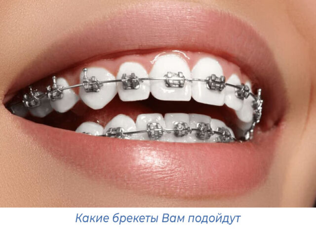 Какие брекеты Вам подойдут