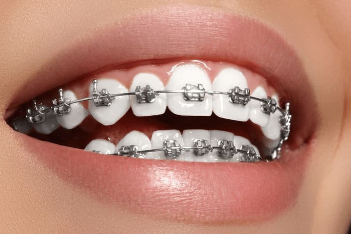Selection of the braces type