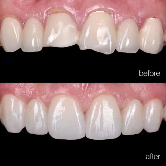 Placement of Veneers
