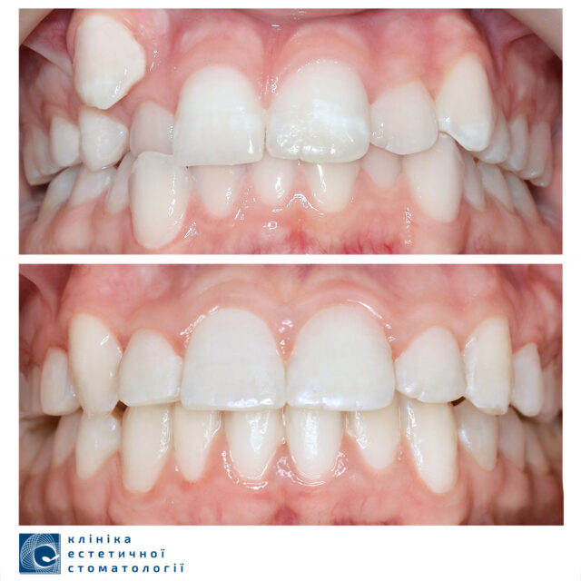 Why Can Braces Hurt photo