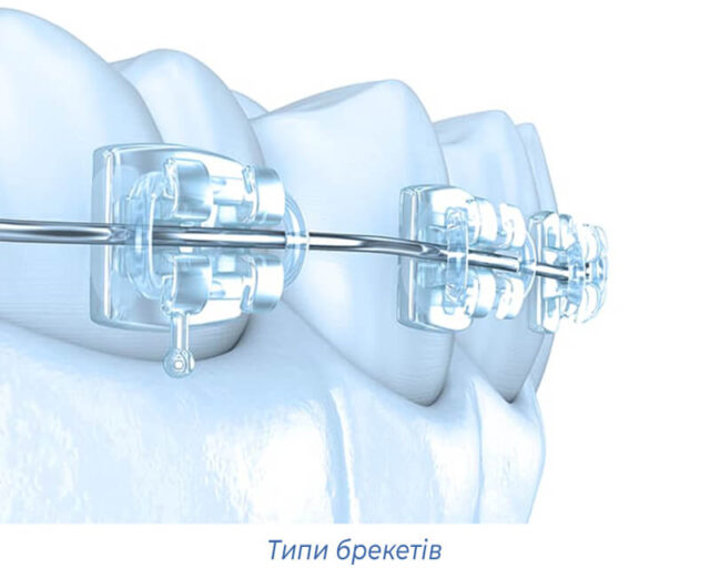 Типи брекетів