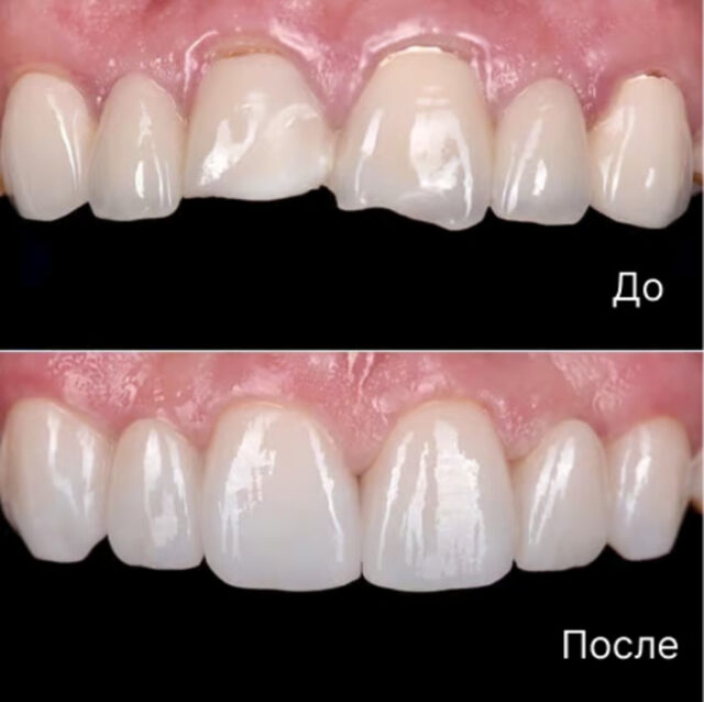 Установка виниров