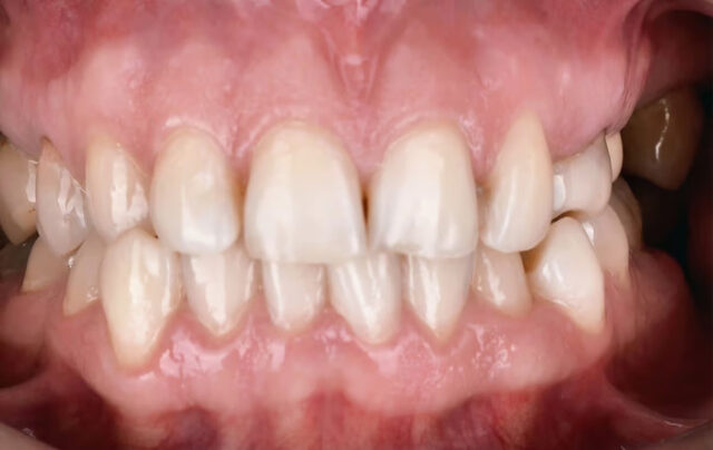 Види перехресних прикусів 