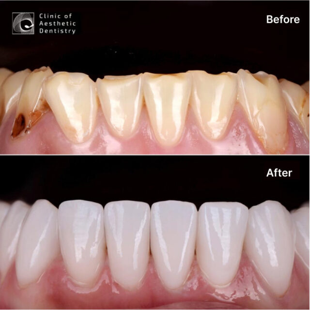 What Is the Ideal Tooth Shape