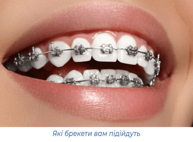 Які брекети вам підійдуть