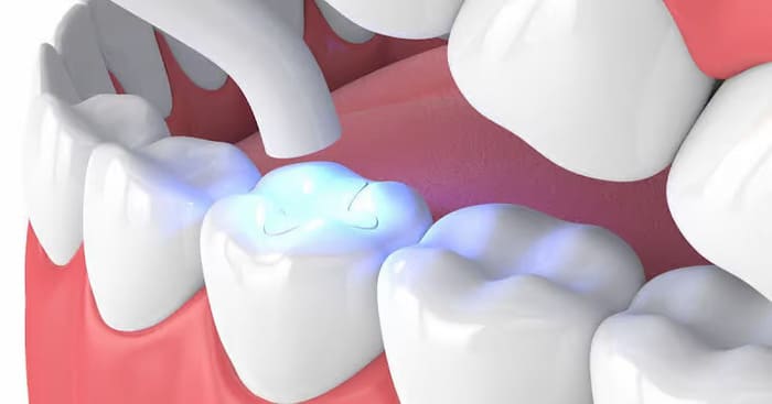 How Does a Dental Filling Work?
