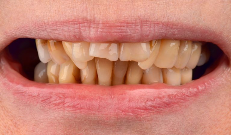 Zirconium crowns as an alternative treatment option for crowded teeth with distal occlusion