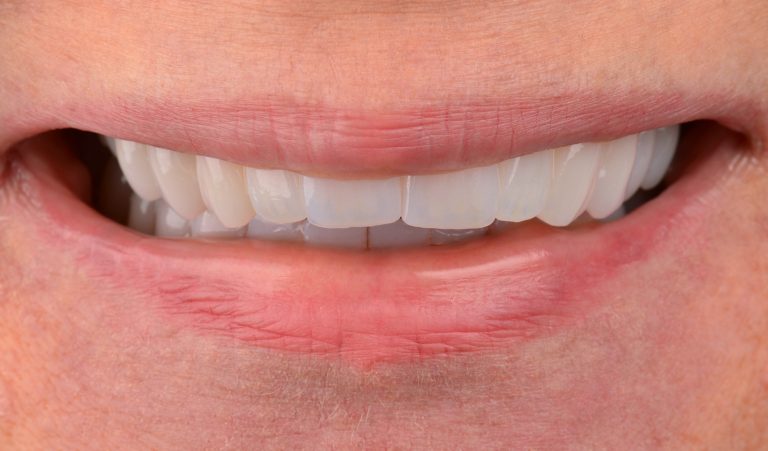 Zirconium crowns as an alternative treatment option for crowded teeth with distal occlusion