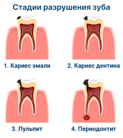 стадии разрушения зуба