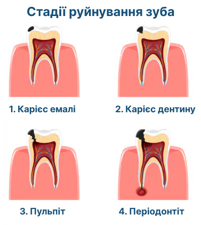 стадії руйнування зуба