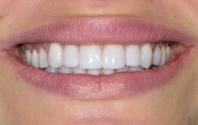 temporary fillings